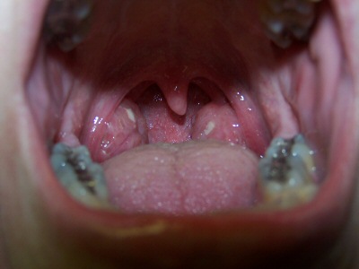 My Tonsils